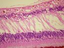 CRAO-macula.JPG