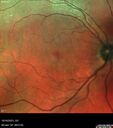 CRVO-cilioretinal-occlusion_117350_101623_03.jpg