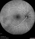 CRVO-cilioretinal-occlusion_117350_101623_12.jpg