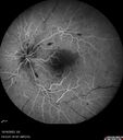 CRVO-cilioretinal-occlusion_117350_101623_15.jpg