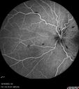 CRVO-cilioretinal-occlusion_117350_101623_20.jpg