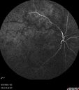 CRVO-non-ischemic-121875-1-092724_09.jpg