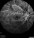 CRVO-non-ischemic-121875-1-092724_13.jpg