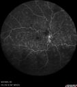 CRVO-non-ischemic-121875-1-092724_18.jpg