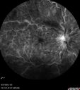 CRVO-non-ischemic-121875-1-092724_20.jpg