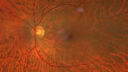 CWS_postAorticDissection_125569_060625_02.jpg