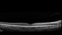 CWS_postAorticDissection_125569_060625_04.jpg