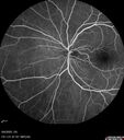 CWS_postAorticDissection_125569_060625_19.jpg