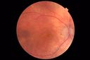 Choroidal-thickening-stma_052418_01.JPG