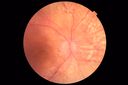 Choroidal-thickening-stma_052418_02.JPG