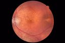 Choroidal-thickening-stma_052418_03.JPG