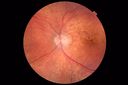 Choroidal-thickening-stma_052418_04.JPG