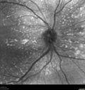 Choroidal-thickening-stma_052418_06.jpg