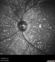 Choroidal-thickening-stma_052418_08.jpg