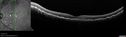 Choroidal-thickening-stma_052418_19.jpg