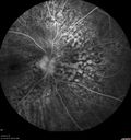 Choroidal-thickening-stma_052418_32.jpg