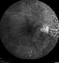 Choroidal-thickening-stma_052418_33.jpg