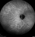 Choroidal-thickening-stma_052418_46~0.jpg