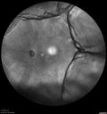 Choroidals_hypotony_02.jpg