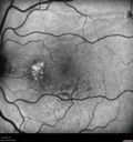 Choroidals_hypotony_04.jpg