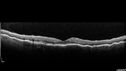 Choroidals_hypotony_05.jpg