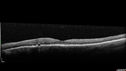 Choroidals_hypotony_06.jpg