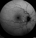Chronic-endo_macro_020619_0005.jpg