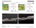 DME_ischemia_hedyc_033023_07.JPG