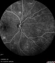 DME_ischemia_hedyc_033023_15.jpg