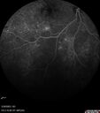 DME_ischemia_hedyc_033023_17.jpg