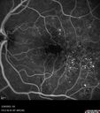 DME_ischemia_hedyc_033023_20.jpg