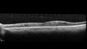 DR-Macular-Ischemia_126599_080825_03.jpg
