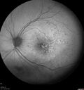 DR-Macular-Ischemia_126599_080825_06.jpg