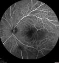 DR-Macular-Ischemia_126599_080825_08.jpg