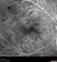 DR-Macular-Ischemia_126599_080825_17.jpg