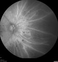 DR-Macular-Ischemia_126599_080825_20.jpg