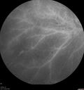 DR-Macular-Ischemia_126599_080825_21.jpg