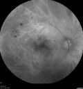 DR-Macular-Ischemia_126599_080825_22.jpg