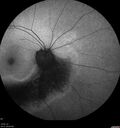 Dystrophy-genenegative_arfer_040821_14.jpg