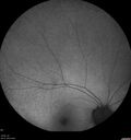 Dystrophy-genenegative_arfer_040821_16.jpg