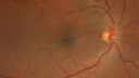 ETOHamblyopia_ancar_040820_01.png