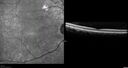 ETOHamblyopia_ancar_040820_03.jpg