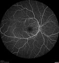 ETOHamblyopia_ancar_040820_09.jpg