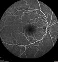ETOHamblyopia_ancar_040820_10.jpg