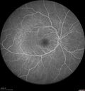 ETOHamblyopia_ancar_040820_11.jpg