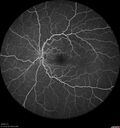 ETOHamblyopia_ancar_040820_12.jpg