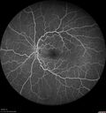 ETOHamblyopia_ancar_040820_14.jpg