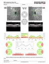 ETOHamblyopia_ancar_040820_16.JPG