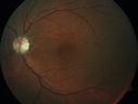 HereditaryAD-optic-atrophy_hearc_120119_04.jpg