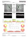HereditaryAD-optic-atrophy_hearc_120119_07.JPG